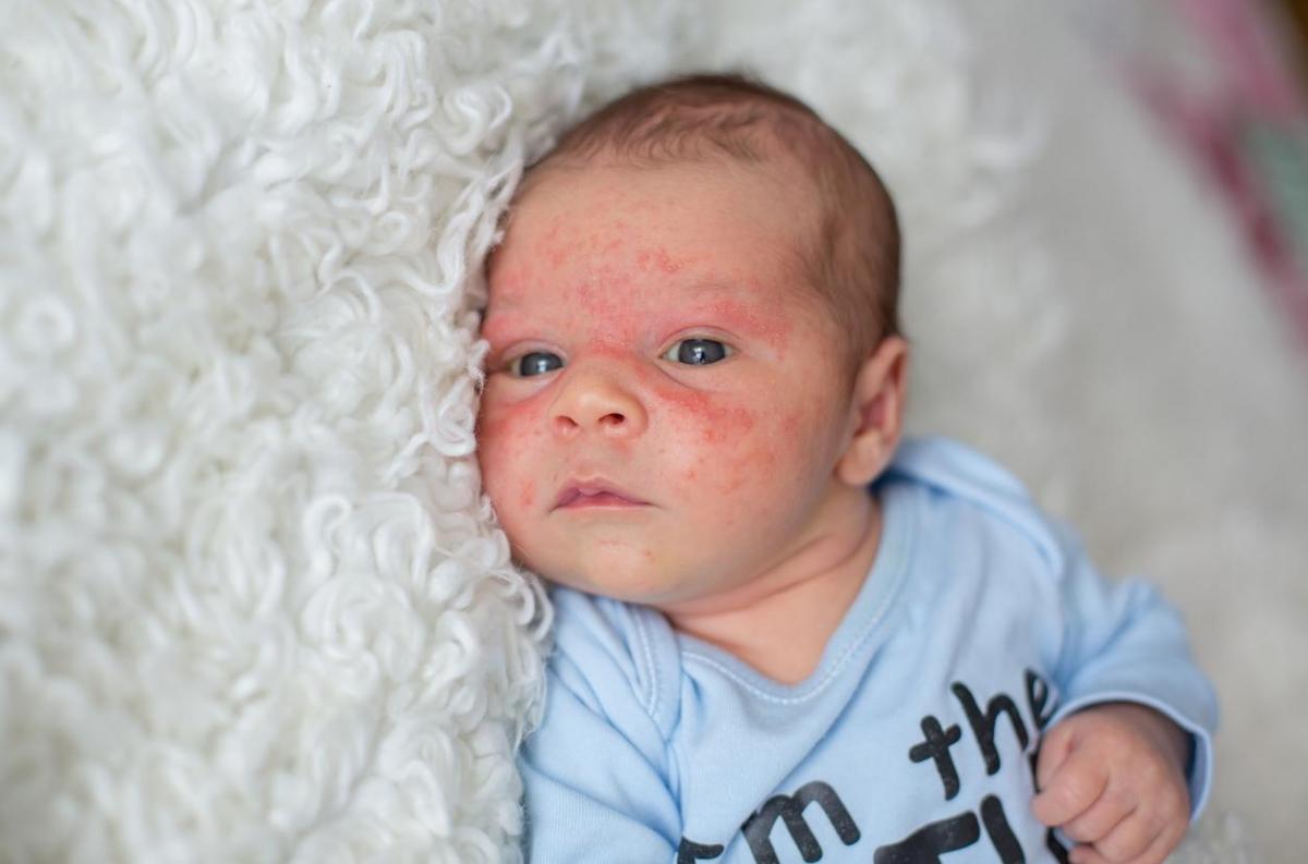 bébé souffrant d'eczéma