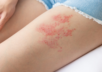 Accueil Image d'une jambe infectée par un zona